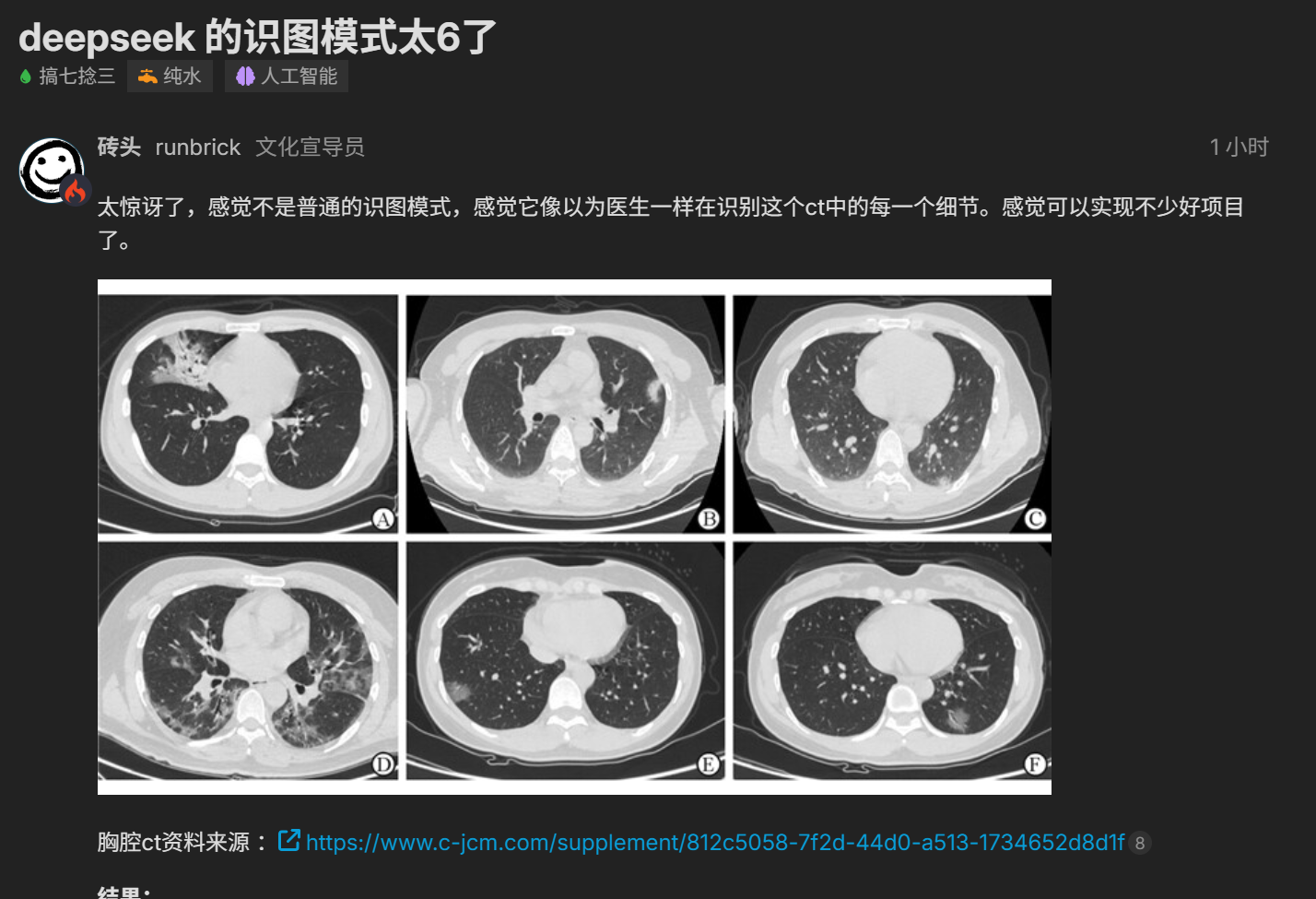 新版DeepSeek识图功能还能读懂CT图
