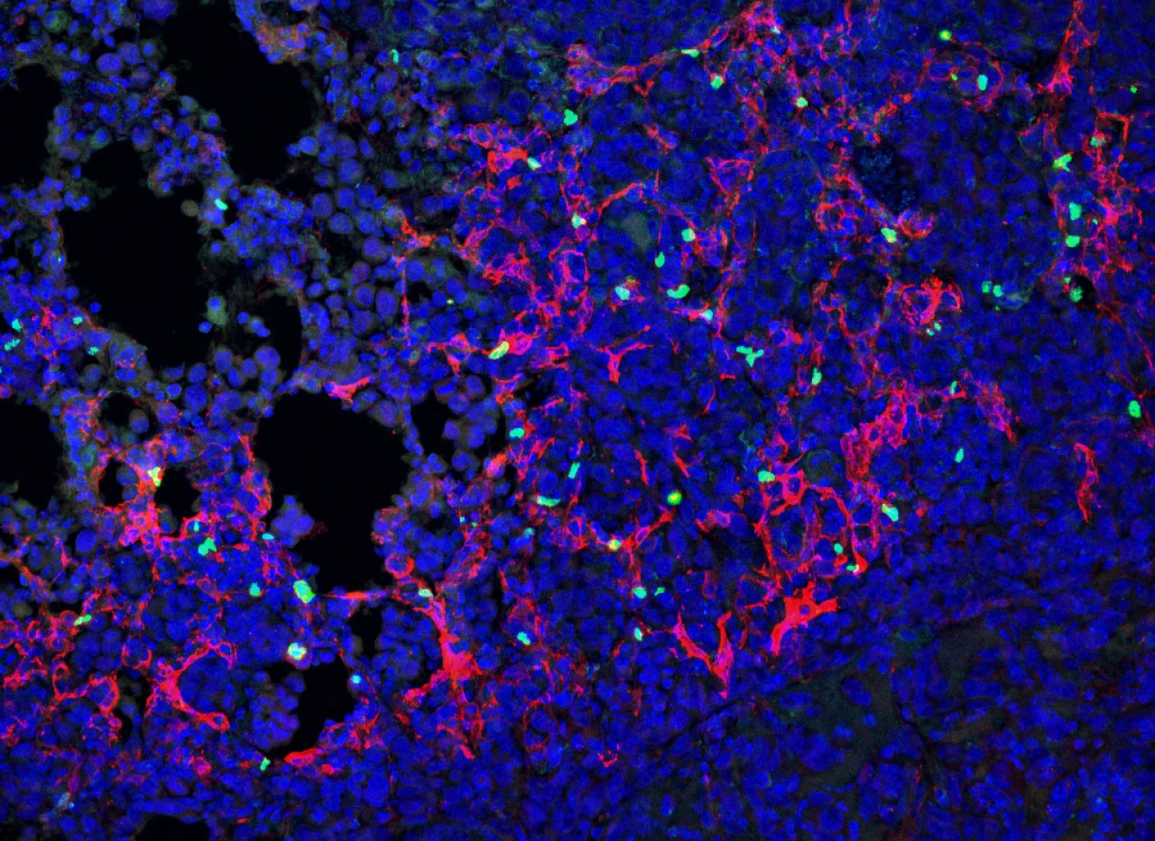 科学家发现帮助肺癌逃避免疫系统的隐蔽细胞 或为癌症治疗带来新靶点
